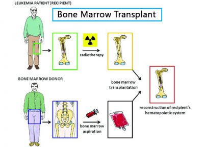 icd 10 code for pre bone marrow transplant