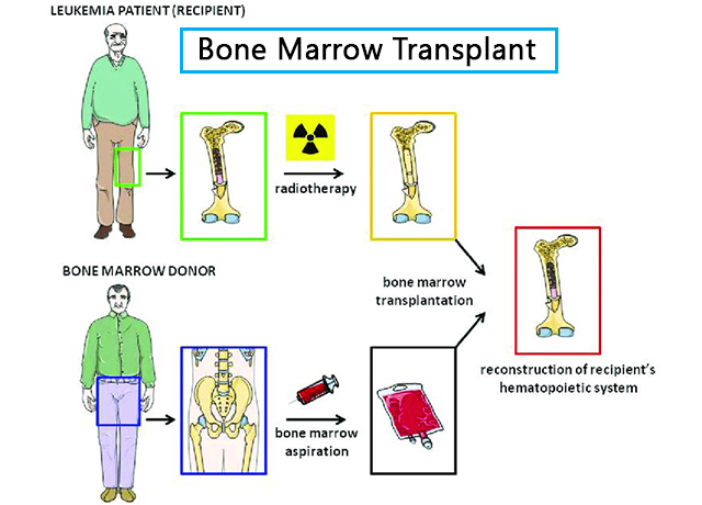 Bone Marrow Transplant Reason And Procedure Of Trasnplant