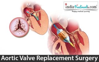 Aortic Valve Replacement Surgery