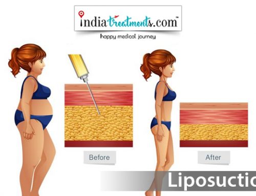 Liposuction – Indiatreatments