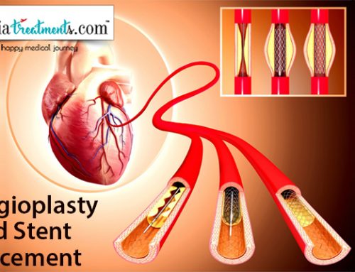 Angioplasty and Stent Placement