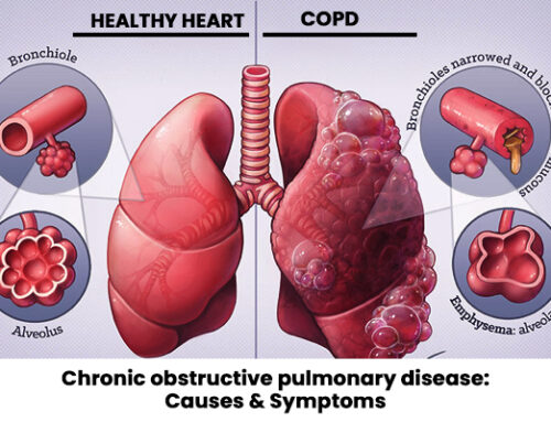 Chronic obstructive pulmonary disease: Causes & Symptoms