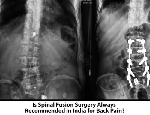 Is Spinal Fusion Surgery Always Recommended in India for Back Pain?