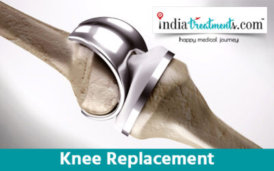 Knee Replacement