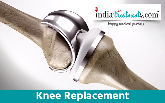 Knee Replacement