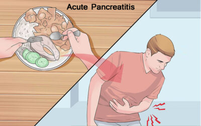 Acute Pancreatitis