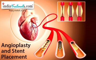 Angioplasty and Stent Placement