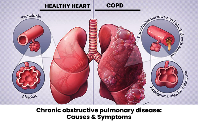 Chronic obstructive pulmonary disease: Causes & Symptoms