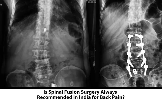 Is Spinal Fusion Surgery Always Recommended in India for Back Pain?