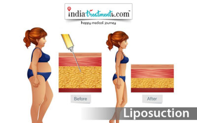 Liposuction