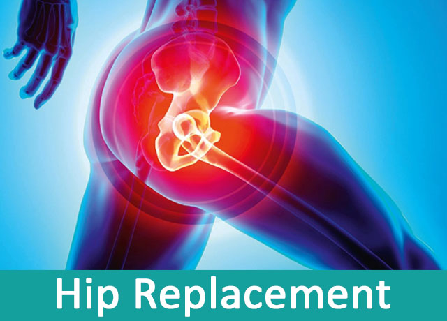 Hip Replacement